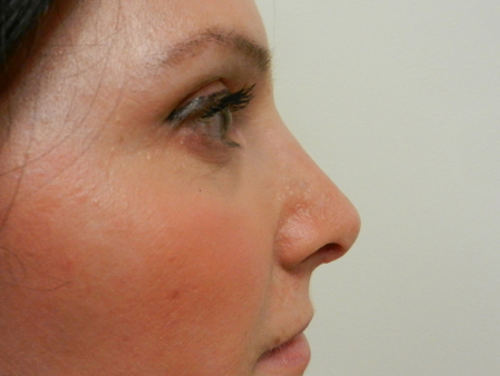 After Image: Patient # 33656 - 