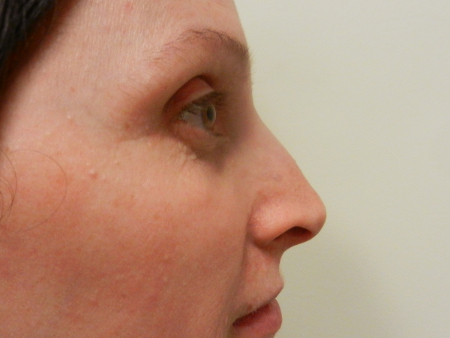 Before Image: Patient # 33656 - 