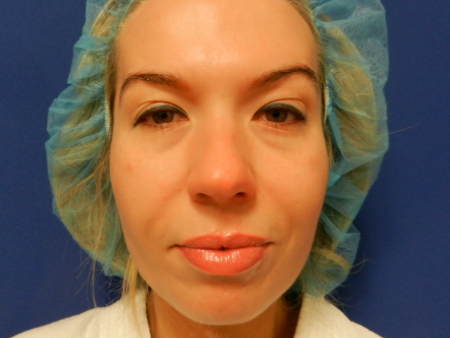 Before Image: Patient # 10257 - 