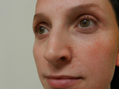 Before Image: Patient # 33656 - 