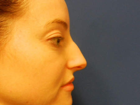 Before Image: Patient # 51244 - 