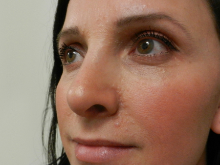 After Image: Patient # 33656 - 
