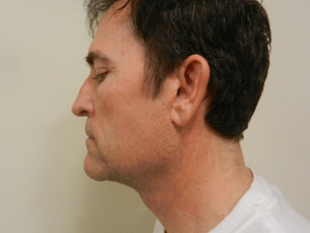 After Image: Patient # 32910 - 