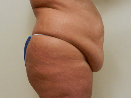 Before Image: Patient # 75612 - 
