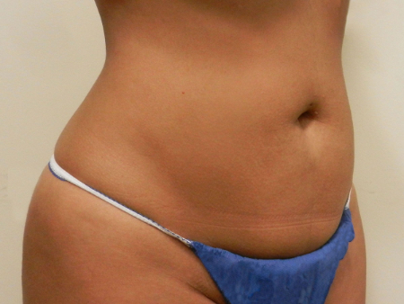 After Image: Patient # 80607 - 