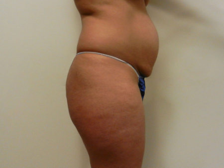 Before Image: Patient # 95849 - 