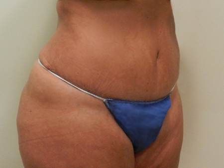 After Image: Patient # 75612 - 