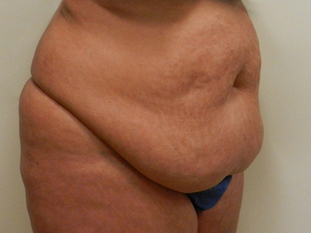 Before Image: Patient # 75612 - 