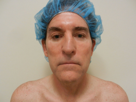 After Image: Patient # 32910 - 