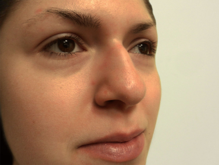 Before Image: Patient # 49757 - 