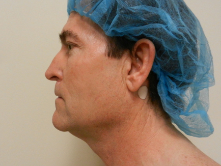Before Image: Patient # 32910 - 