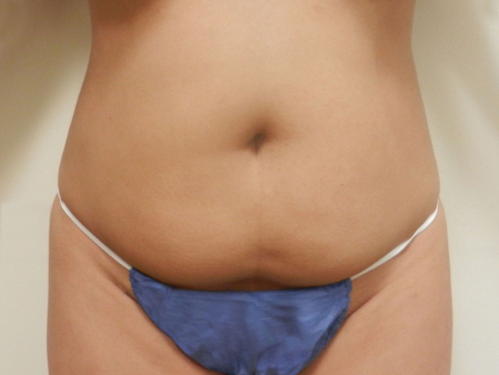 Before Image: Patient # 80607 - 
