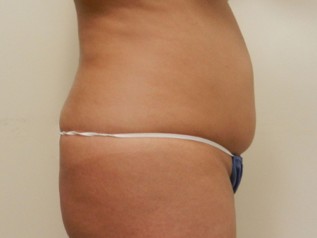 Before Image: Patient # 80607 - 
