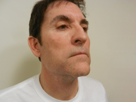 Before Image: Patient # 32910 - 