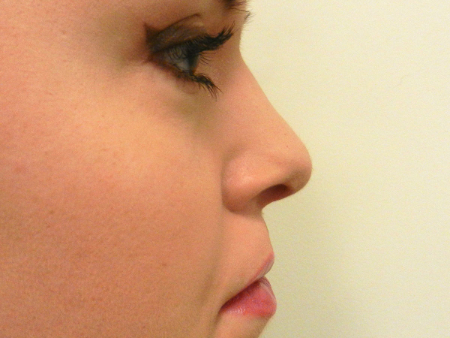 After Image: Patient # 49757 - 
