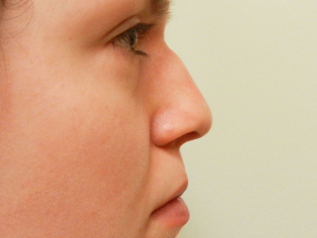 Before Image: Patient # 49757 - 