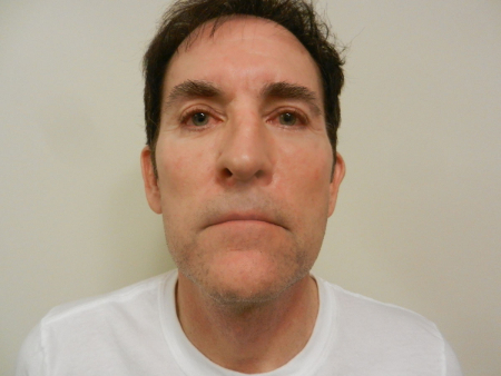 After Image: Patient # 32910 - 