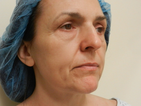 Before Image: Patient # 95309 - 