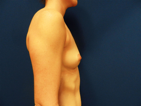 Before Image: Patient # 67085 - 