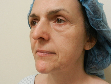 Before Image: Patient # 95309 - 