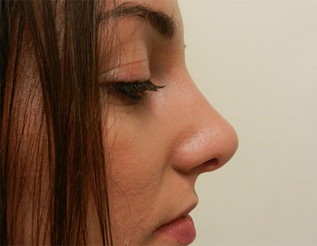 After Image: Patient # 67046 - 