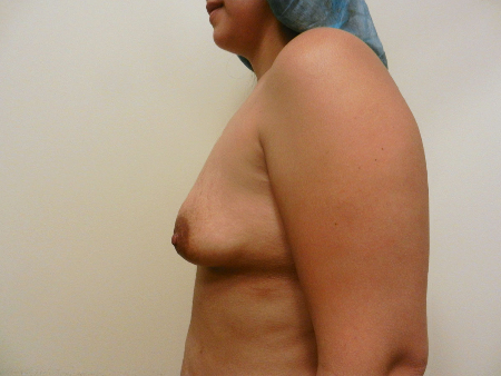 Before Image: Patient # 90590 - 