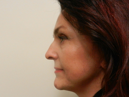 After Image: Patient # 95309 - 