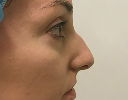Before Image: Patient # 67046 - 