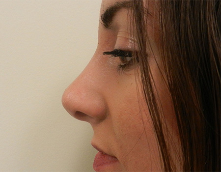 After Image: Patient # 67046 - 