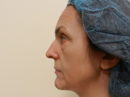 Before Image: Patient # 95309 - 