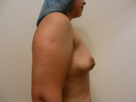 Before Image: Patient # 90590 - 