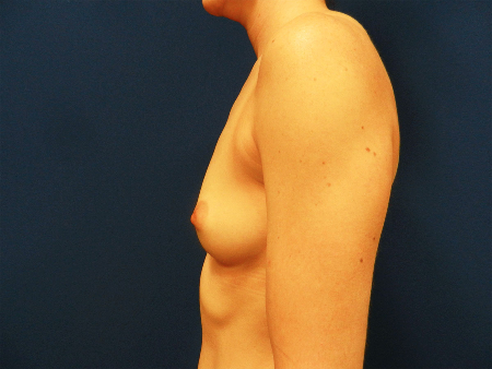 Before Image: Patient # 67085 - 