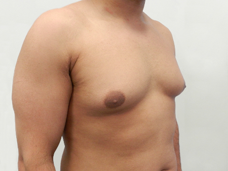 Before Image: Patient # 85461 - 