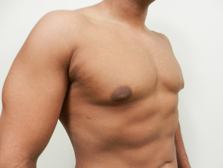 After Image: Patient # 85461 - 