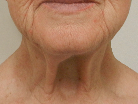 Before Image: Patient # 79225 - 