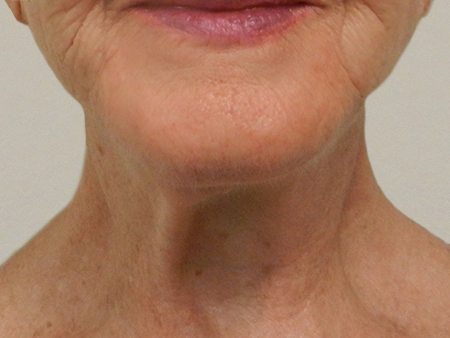 After Image: Patient # 79225 - 