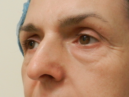 Before Image: Patient # 96510 - 