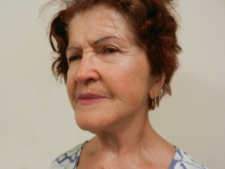 After Image: Patient # 79225 - 