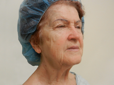 Before Image: Patient # 79225 - 