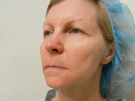 Before Image: Patient # 52315 - 