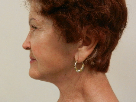 After Image: Patient # 79225 - 