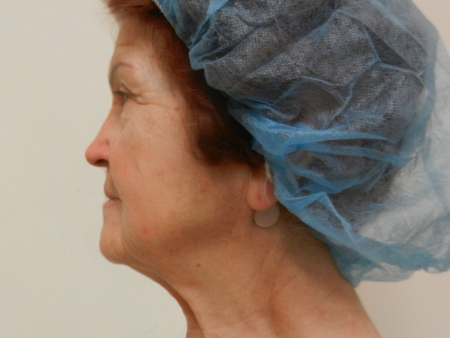 Before Image: Patient # 79225 - 