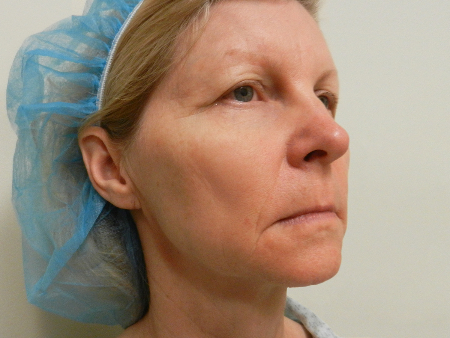 Before Image: Patient # 52315 - 