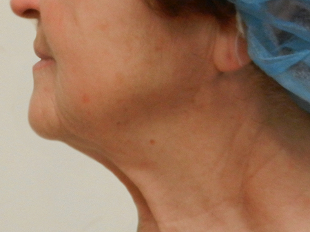Before Image: Patient # 79225 - 