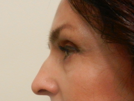 After Image: Patient # 35271 - 