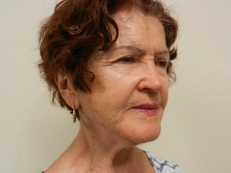 After Image: Patient # 79225 - 
