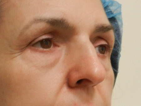 Before Image: Patient # 35271 - 
