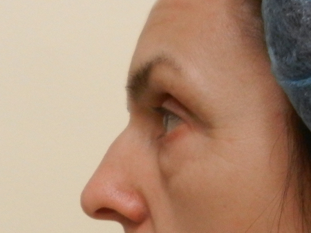 Before Image: Patient # 96510 - 