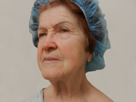 Before Image: Patient # 79225 - 