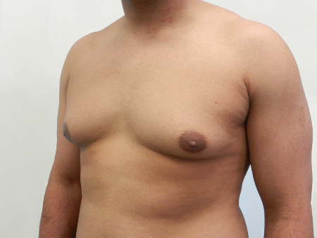 Before Image: Patient # 85461 - 